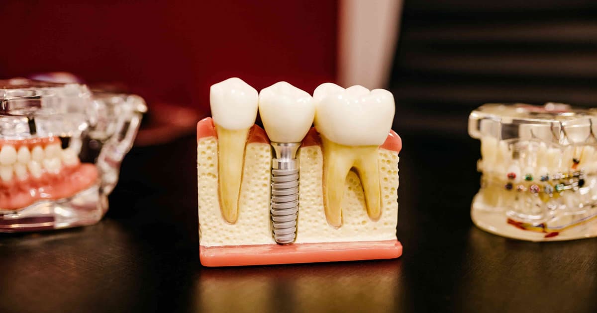 5 Reasons Why Dental Implants are the Ultimate Tooth Replacement Solution