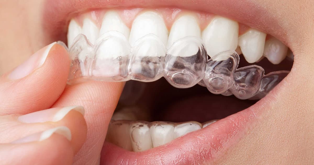 Get Ready for Invisalign Week — September 22–26!