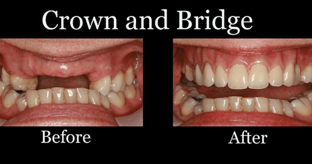 The Enigmatic Craftsmanship Behind Dental Bridges and Crowns