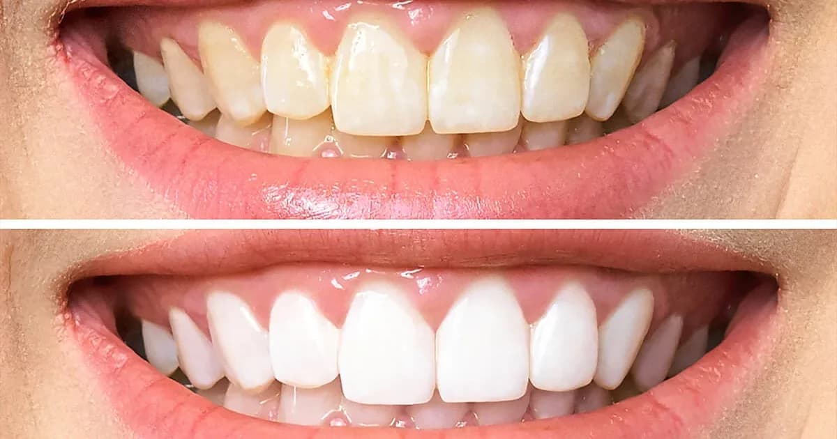 The Inside Scoop On Teeth Whitening