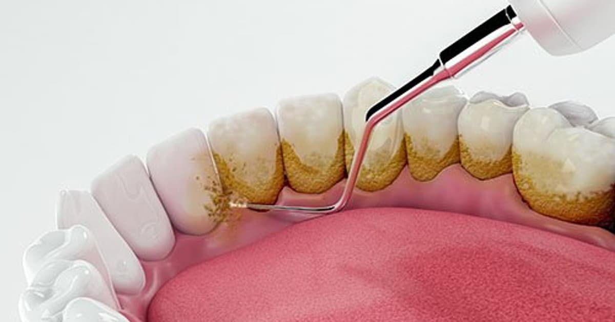 Unraveling the Mystery of Dental Plaque: A Microscopic Adventure