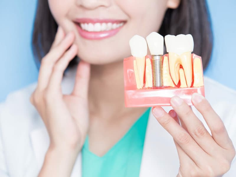 Dental implant model showing titanium post, abutment, and porcelain crown